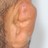 Cauliflower_Ear
